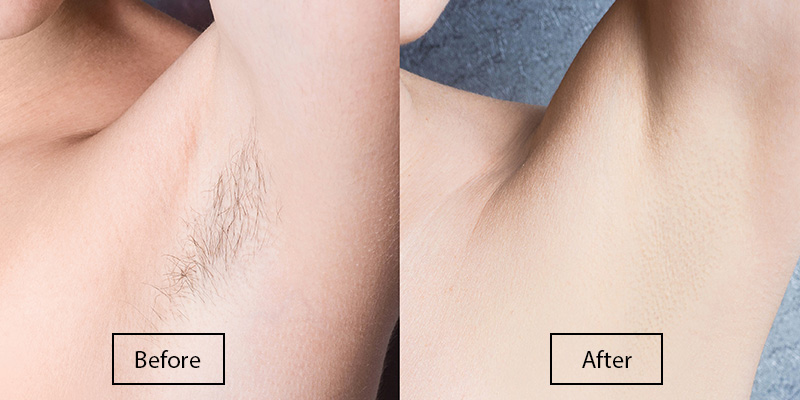 703-underarm-laser-hair-removal-before-after.jpg